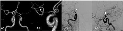 Natural course and risk factors of moyamoya disease with unruptured intracranial aneurysm